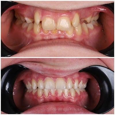 Butik Dental Ortodonti Uzmanı Dr. Yusuf Ozan Topçu Diş Hekimi Dt. Özge Topçu Ortodonti İzmir şeffaf plak tedavi merkezi
