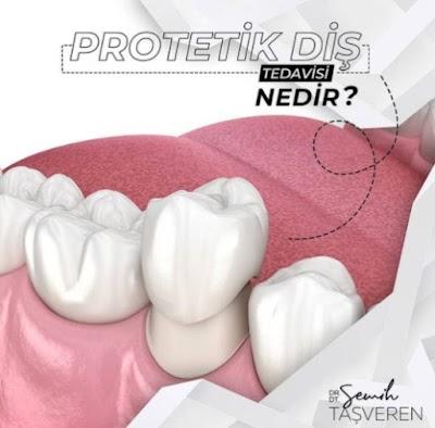 Dr. Dt. Semih Taşveren, Protetik Diş Tedavisi