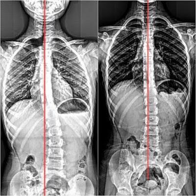 Uzman Fizyoterapist Tansu YAŞİN Fizyoterapi ve Skolyoz Merkezi