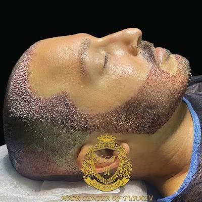 Hair Center Of Turkey