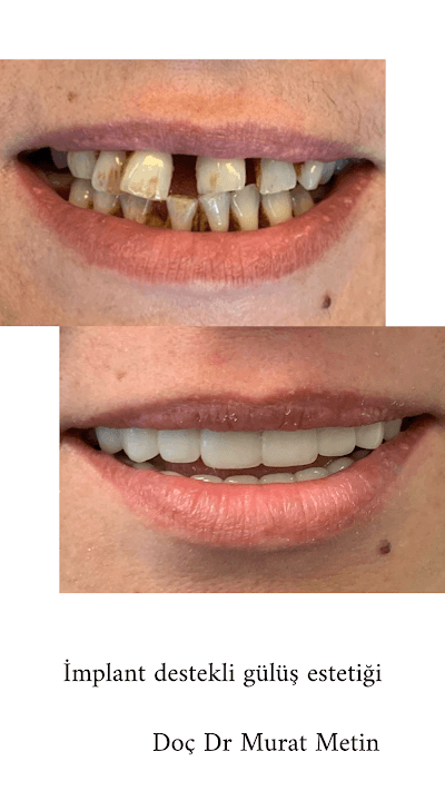 Doç Dr Murat Metin Ağız Diş Çene Cerrahisi Ve İmplant Kliniği