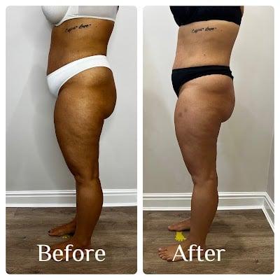 Endermika -Endermologie LPG, body sculpting, non invasive Lymphatic Drainage Massage, Post-Operative Lymphatic