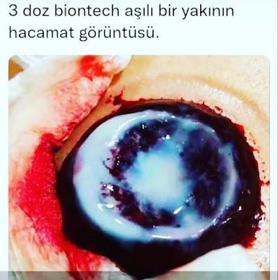 antalya hacamat terapi merkezi