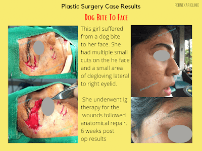 Dr Amey Pednekar | Plastic Reconstructive & Aesthetic Surgeon | Botox, Breast Surgery, Fillers