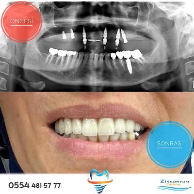 ZİRKONYUM DENTAL AĞIZ VE DİŞ SAĞLIĞI POLİKLİNİĞİ