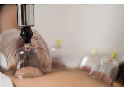 Isparta Bayan Hacamat Tedavisi