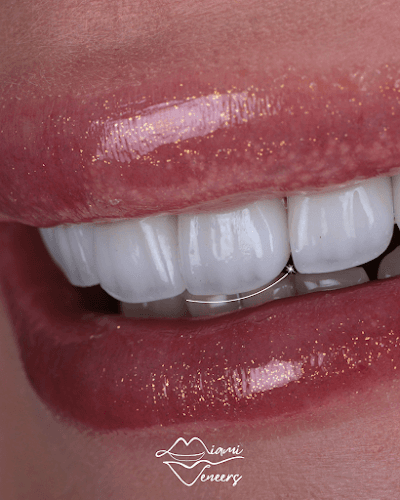 Miami Veneers and Modern Dentistry
