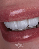 Miami Veneers and Modern Dentistry