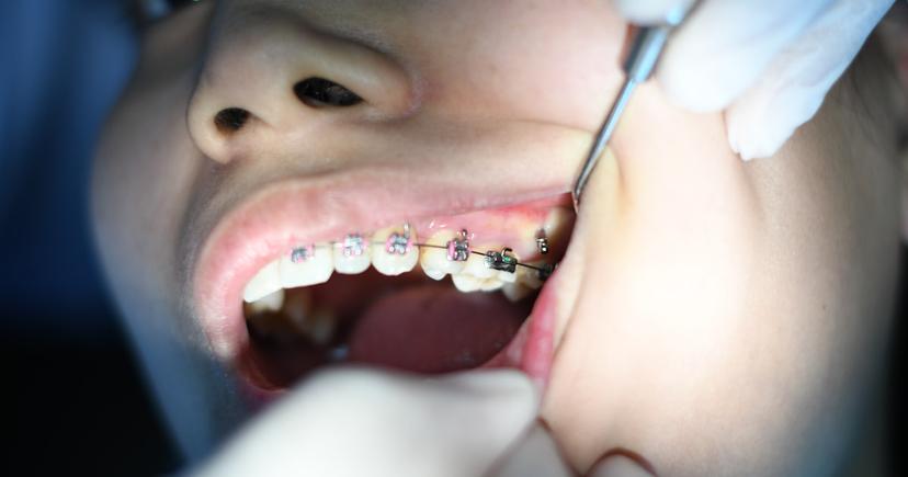 All-on-4 Dental Implants in Turkey: Complete 2026 Cost Breakdown